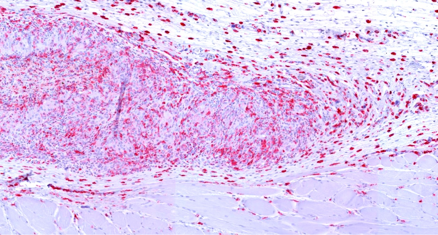 CD163 immunohistochemistry of macrophage response around collagen matrix