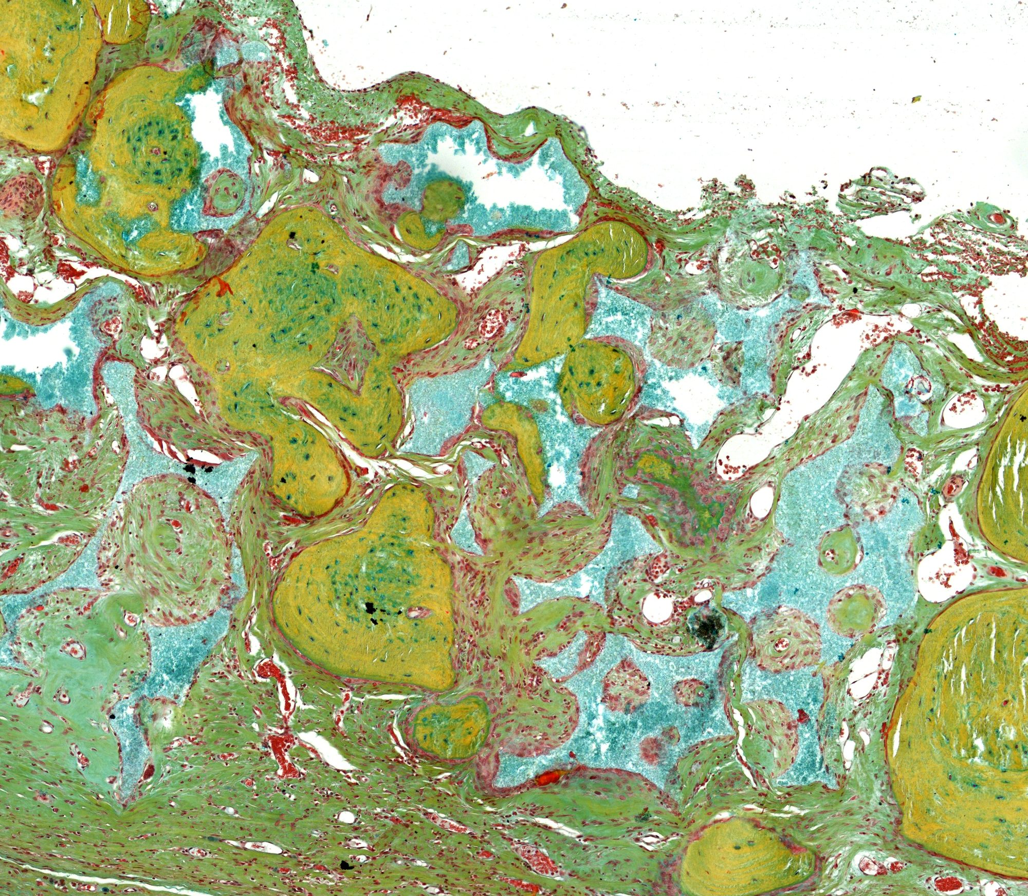Movat pentachrome, bone integration